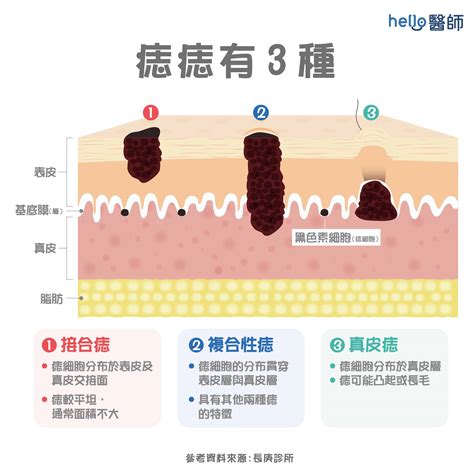 痣流血原因